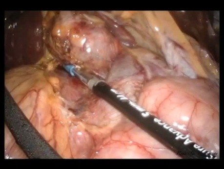 Laparo-Endoscopic Single Site (LESS) Adrenalectomy For Resection of Pheochromocytoma