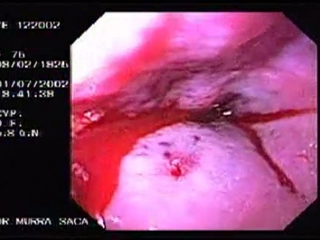 Hemorrhage due status post rubber band ligation of esophageal varices (17 of 25)