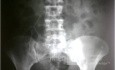 Nephrolithiasis Sinistra