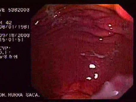 Recurrent Pseudoachalasia - Necessity of New Dilatation