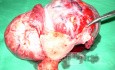 Large Fundal Fibroid