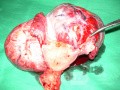 Large Fundal Fibroid