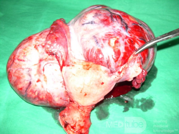 Large Fundal Fibroid