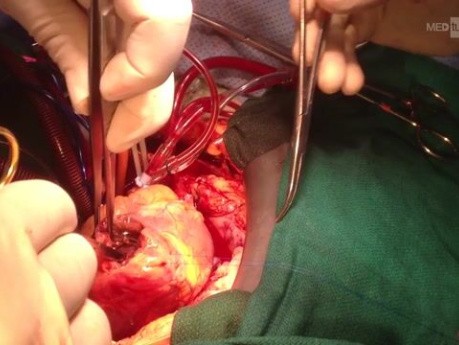 Demonstration of Anteroir VSD
