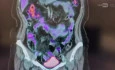 Resection of lymph node suspected of metastasis in retroperitoneum