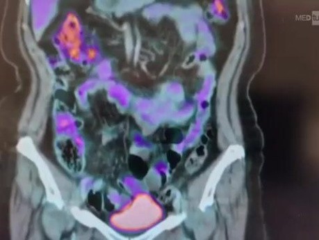 Resection of lymph node suspected of metastasis in retroperitoneum