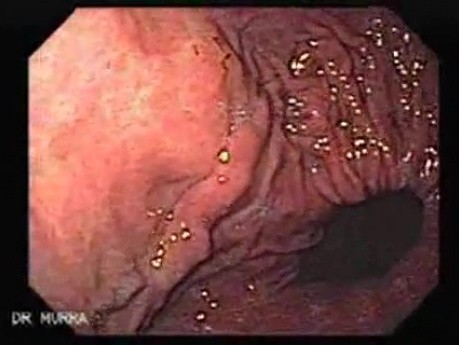 Esophageal Varices and Hiatus Hernia (2 of 3 )