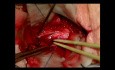 Hemangioblastoma of the Cervical Spine C2
