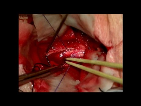 Hemangioblastoma of the Cervical Spine C2