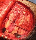 Surgical Planning with Neuronavigator in Patient with Intracranial Mass Lesion. High Grade Glioma.