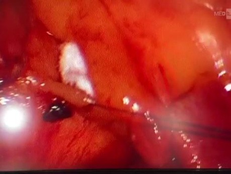 Endoscopic ASD Closure
