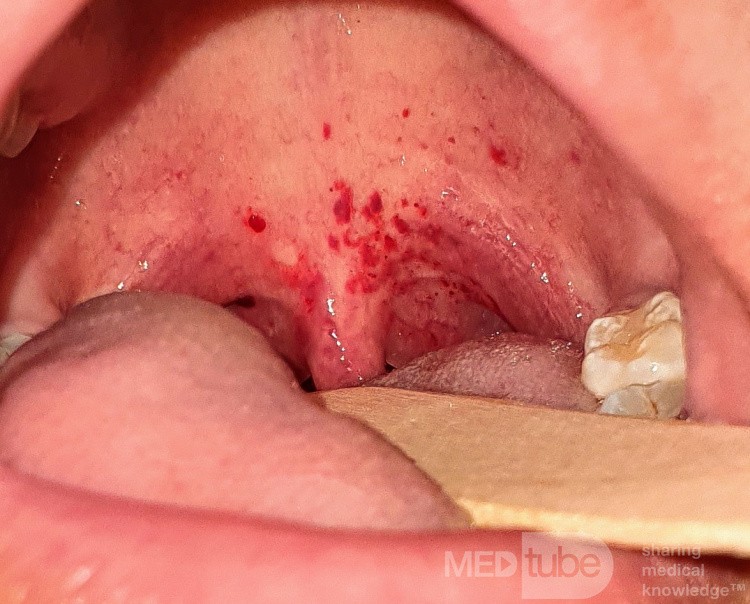 Palatal Patechiae & Ecchymosis 