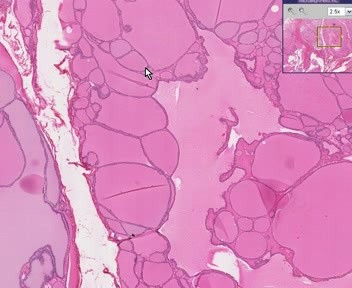 Thyroid - Colloid Goiter