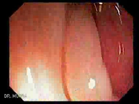 Colon Cancer - Endoscopy (1 of 3)