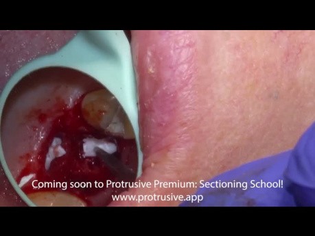 Bleeding Sockets Management Clinical Exodontia