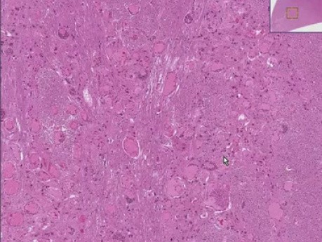 Arteriovenous malformation