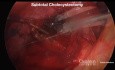 Management of the Difficult Gallbladder