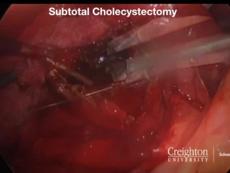 Management of the Difficult Gallbladder