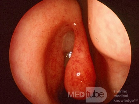 Sentinal Nasal Polyp {right}