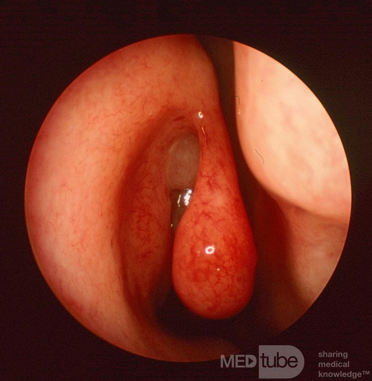Sentinal Nasal Polyp {right}