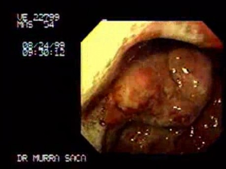 Advanced Carcinoma of the Gastric Body - Endoscopy