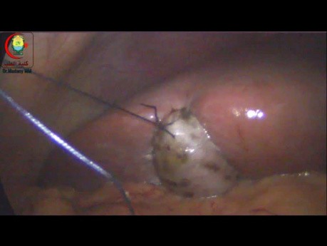 Tough GB Can be Retracted with Sutures