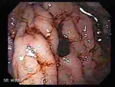Dieulafoy´s Lesion (Exulceratio Simplex) (1 of 9)