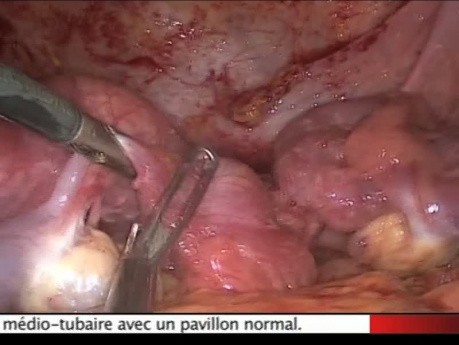 Genital Tuberculosis