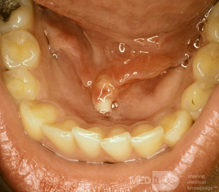 Left Submandibular Duct Stone