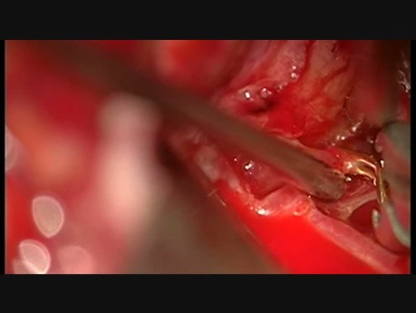 ACo-A Aneurysm - Triple A2