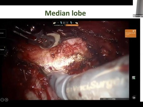 Retzius-sparing RARP