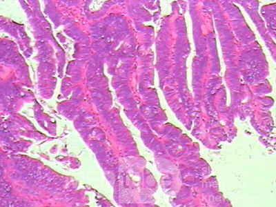 Tubulo - Villous Rectal Adenoma - Endoscopy (28 of 35)