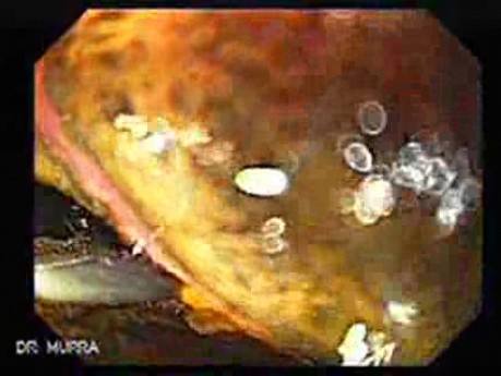 Endoscopic view of Barrett Esophagus -jumbo forceps biopsy (7 of 9)