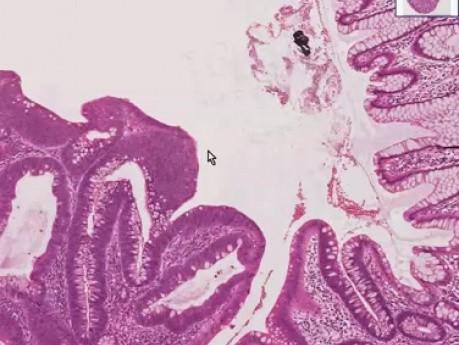 Tubular adenoma - Histopathology - Colon