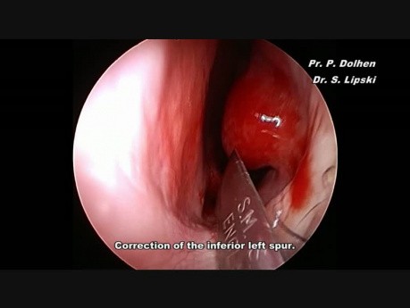 Endoscopic Septoplasty: Small Inferior Spur