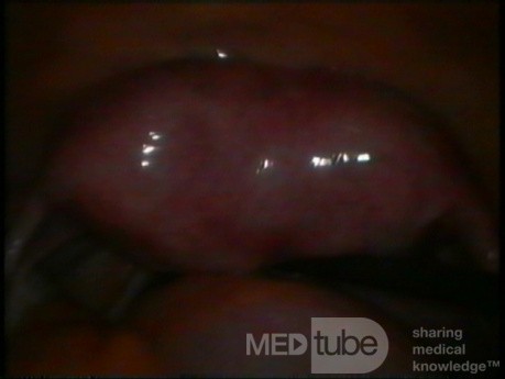 SEPTATE UTERUS BY LAPAROSCOPIC VIEW