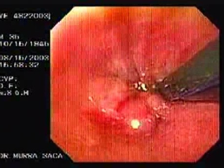Flexible Endoscopic Suturing - Performing the Knot