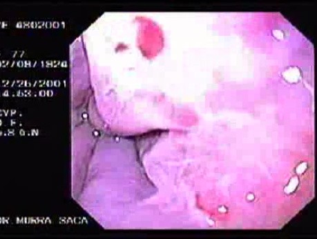 Hemorrhage Due Status Post Rubber Band Ligation of Esophageal Varices - Appearance of the Mucosa