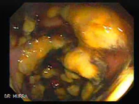 Pseudomembranous Colitis (7 of 11)