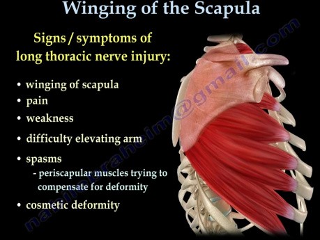 Winging of the Scapula and Treatment Methods