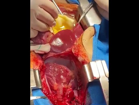 Pediatric Heart Harvest With Retrograde Cardioplegia Manner 