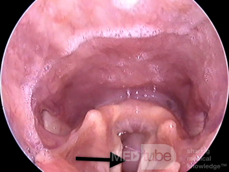 Subglottic Tumor