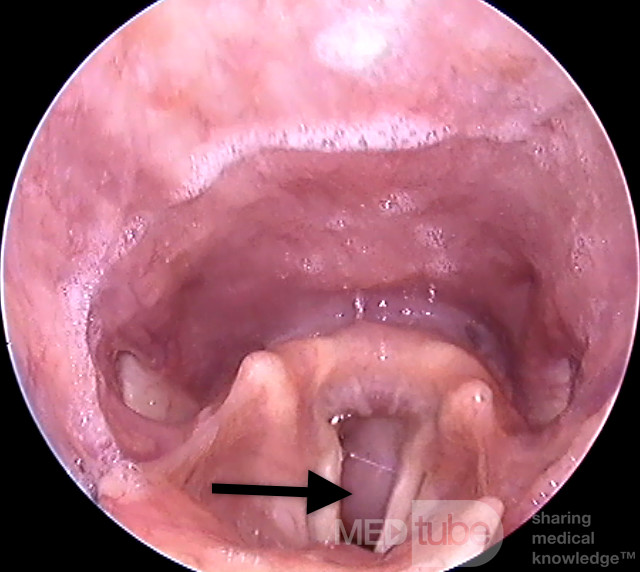 Subglottic Tumor