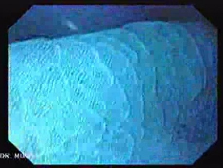 Gastric Folds - Chromoendoscopy (8 of 8)