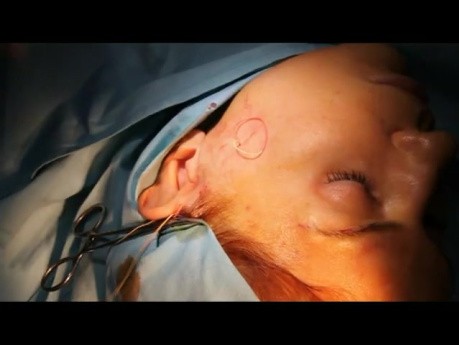 Scarless Mid face lift 