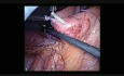 Jejunostomy in the course of treatment of ovarian cancer