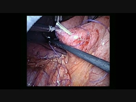 Jejunostomy in the course of treatment of ovarian cancer