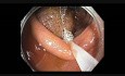 Colonoscopy Channel Quiz 1