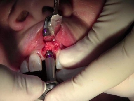 Implant Placement #9 - Screwline Promote Plus, Full Video