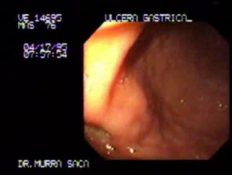 Ulcer of the Gastric Corpus